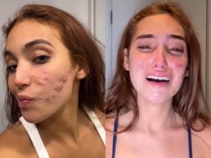 como-funciona-o-tratamento-para-acnes-como-as-de-vanessa-lopes;-especialista-tira-duvidas