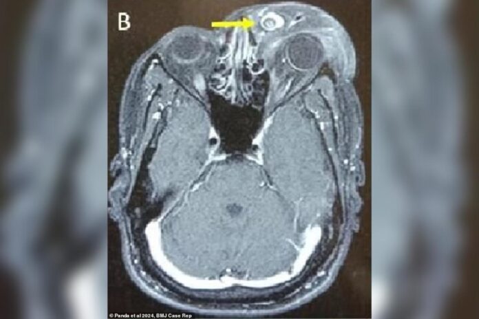 homem-desenvolve-tumor-gigante-apos-parasita-se-alojar-em-seu-olho