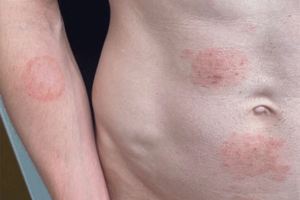 superfungo-genital:-saiba-mais-sobre-infeccao-que-se-espalha-na-europa