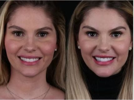 barbara-evans-mexe-no-rosto-apos-remover-excesso-de-gordura-do-corpo.-veja-o-resultado!