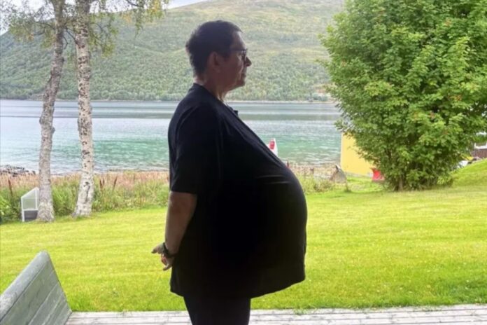 “gordo”:-mal-diagnosticado,-homem-descobre-tumor-de-27-kg-na-barriga