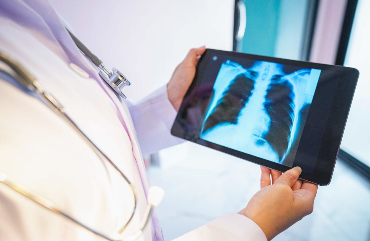 cancer-de-pulmao:-estudo-defende-grupo-ideal-para-rastreio-no-brasil