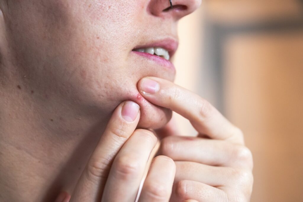 suplemento-de-omega-3-pode-ajudar-a-combater-a-acne,-diz-pesquisa