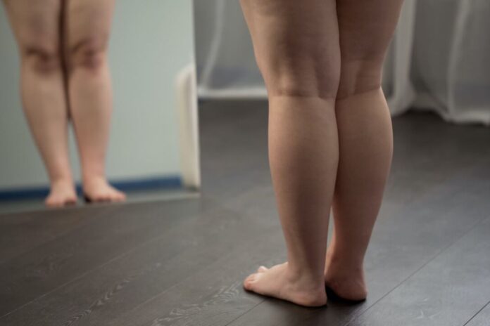 lipedema:-conheca-tratamentos-esteticos-para-controlar-a-condicao