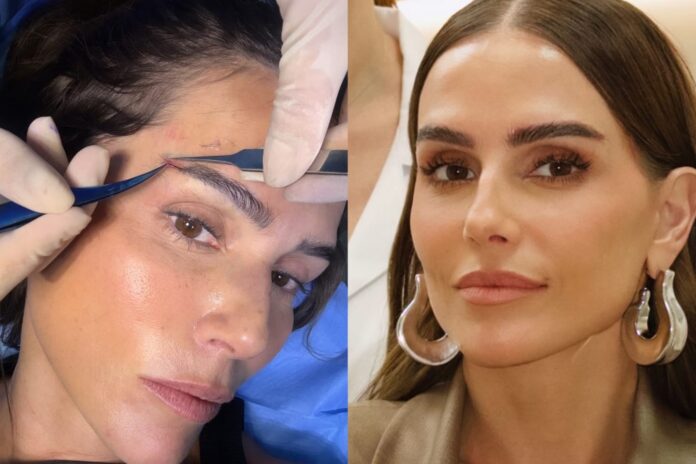 transplante-de-sobrancelha:-entenda-cirurgia-feita-por-deborah-secco