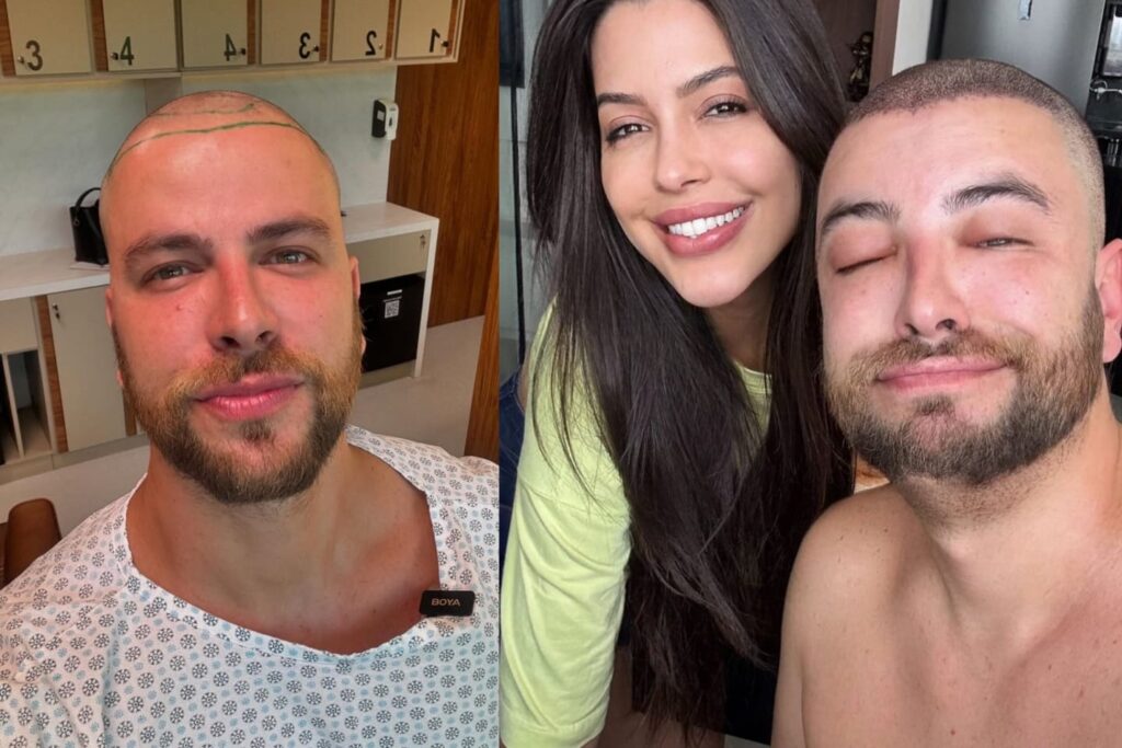 transplante-capilar-fue:-veja-tecnica-usada-no-ex-bbb-gustavo-marsengo