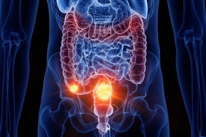 cancer-colorretal-e-um-dos-mais-frequentes-no-brasil.-entenda-a-doenca