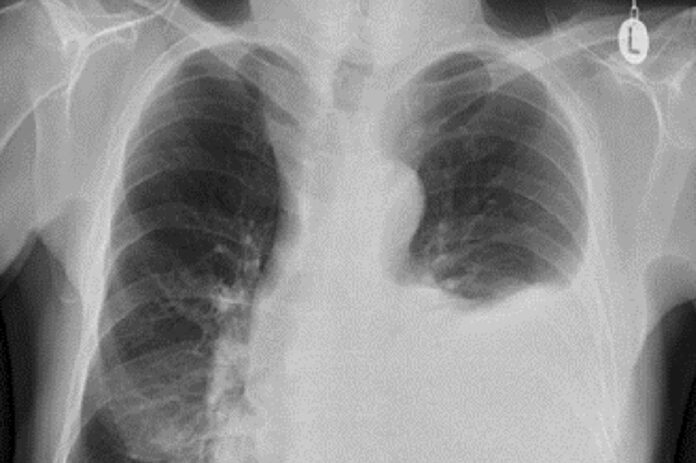 homem-descobre-tumor-no-pulmao-apos-ter-sintoma-inusitado-nas-unhas