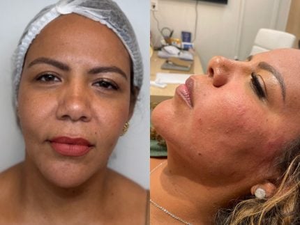 mani-rego-encerra-o-ano-com-harmonizacao-facial-e-exibe-o-resultado