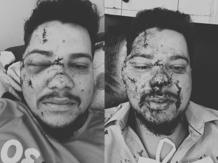 cantor-sertanejo-fica-com-rosto-desfigurado-apos-ser-agredido-com-garrafa