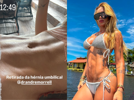 virginia-exibe-resultado-da-barriga-apos-retirada-de-hernia-umbilical