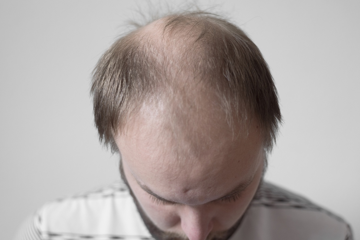 queda-de-cabelo:-estudo-analisa-solucao-barata-e-definitiva