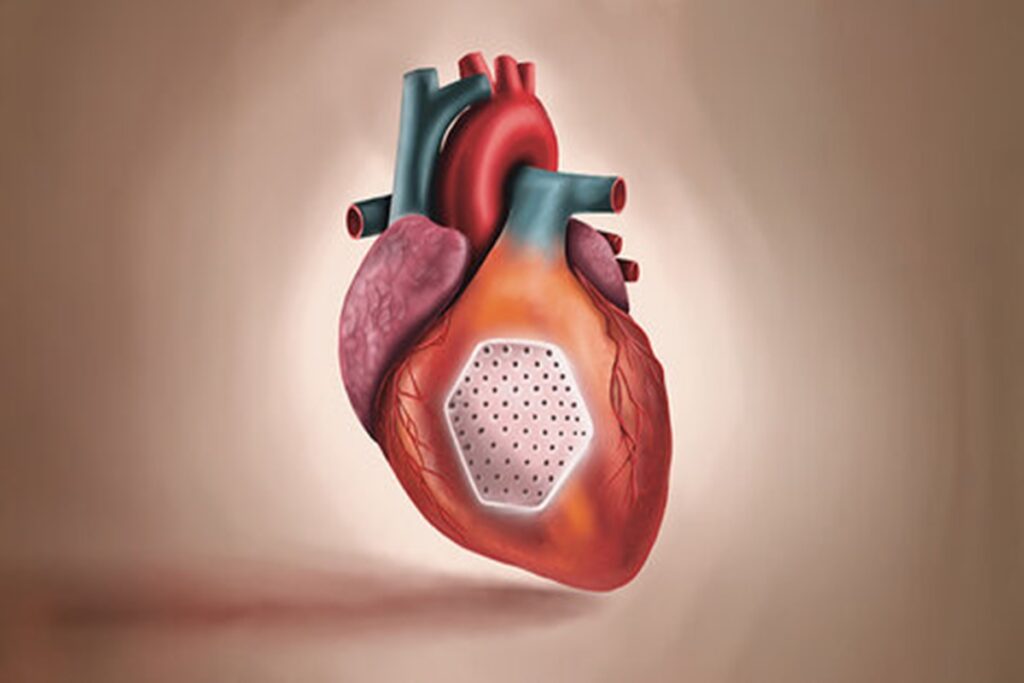 insuficiencia-cardiaca:-adesivo-de-celulas-tronco-pode-regenerar-orgao