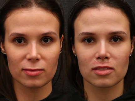 jeniffer-castro,-passageira-da-janela-do-aviao,-passa-por-harmonizacao-facial
