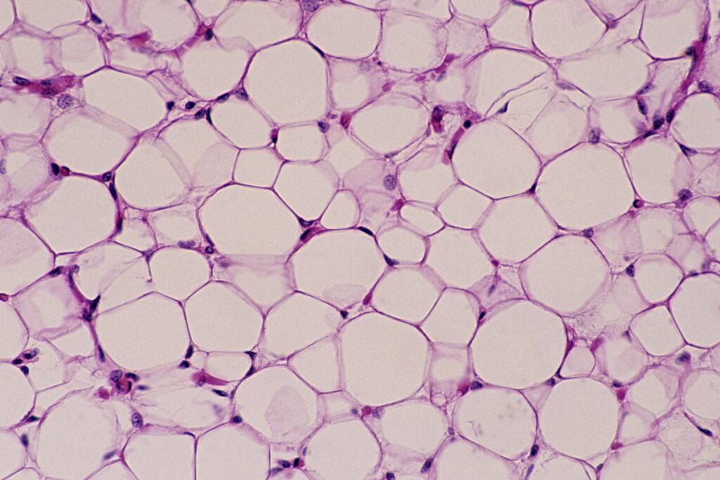 estudo-indica-que-celulas-de-gordura-marrom-podem-matar-as-de-cancer