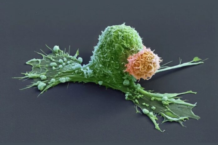 recorde:-jovem-esta-ha-19-anos-em-remissao-de-cancer-com-terapia-car-t