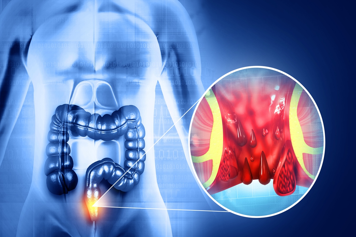 hemorroidas:-conheca-7-habitos-que-aumentam-risco-de-ter-a-inflamacao
