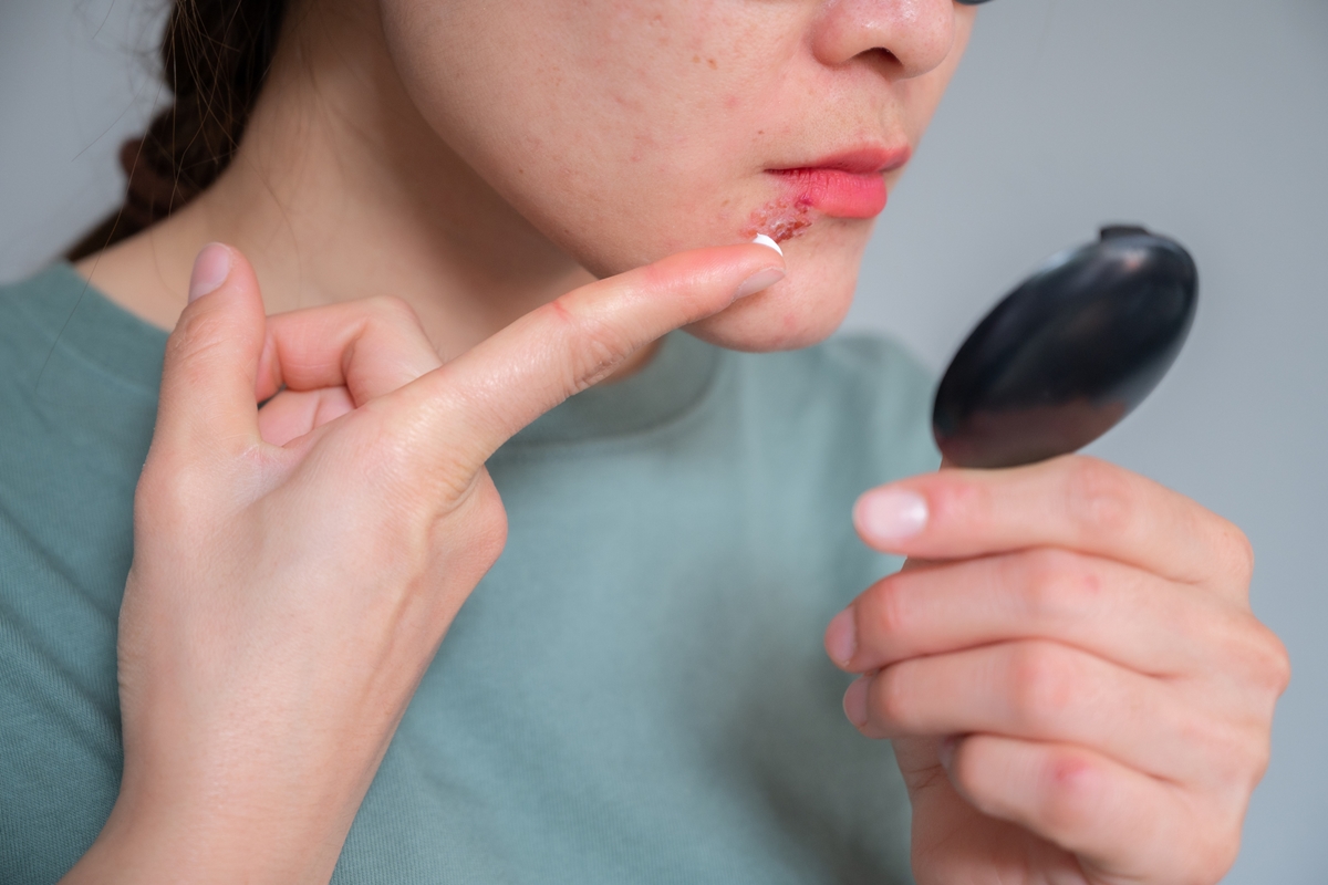 herpes-tem-cura?-entenda-diferentes-tipos-da-doenca-e-tratamentos