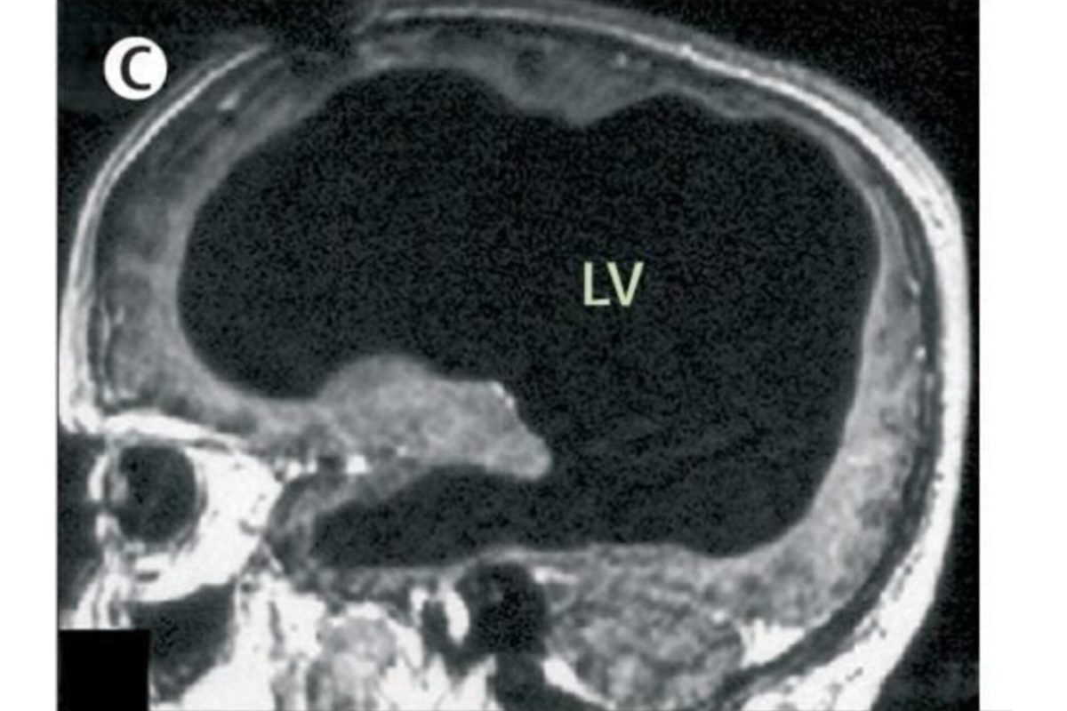 entenda-o-caso-de-homem-que-descobriu-aos-44-anos-ter-o-cerebro-“oco”