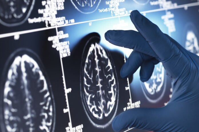 mulher-com-sindrome-de-down-tinha-alzheimer-sem-demencia.-entenda-caso