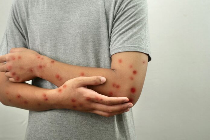 mpox:-o-que-se-sabe-sobre-a-nova-cepa-identificada-no-brasil
