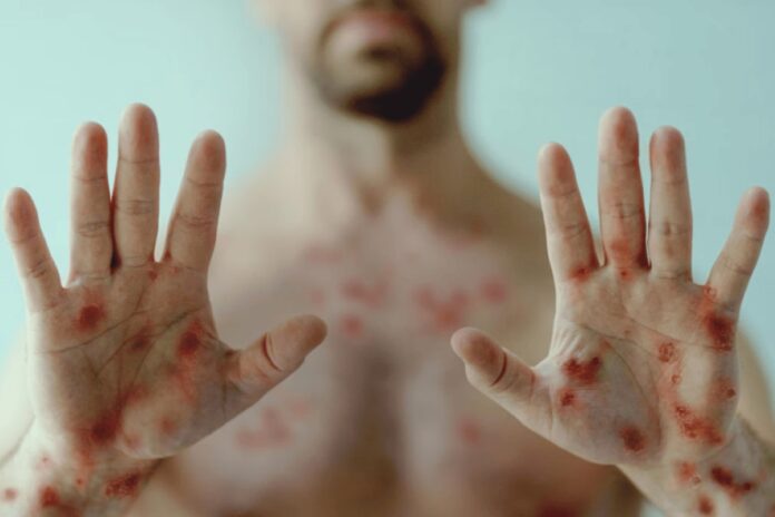 mpox:-conheca-os-primeiros-sinais-e-sintomas-da-doenca