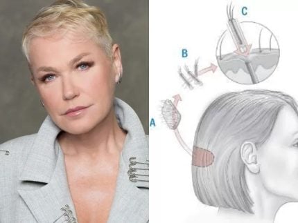 especialista-explica-calvicie-feminina-e-o-implante-capilar-feito-por-xuxa