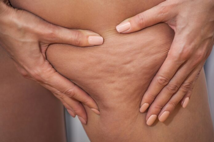 lipedema-ou-celulite?-cirurgia-explica-diferencas-entre-as-condicoes