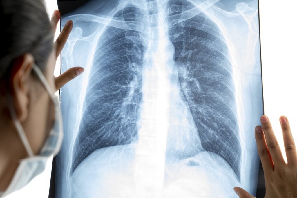 cancer-de-pulmao:-combinacao-de-2-remedios-prolonga-a-vida,-diz-estudo