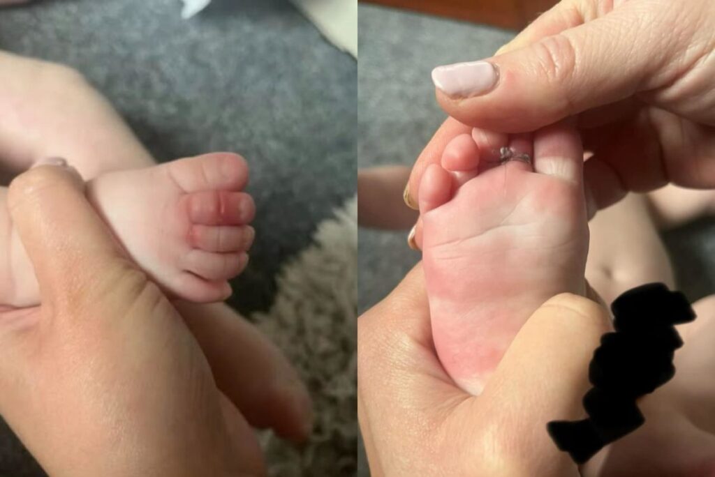 mae-faz-alerta-sobre-lavagem-de-roupa-apos-bebe-quase-perder-os-dedos