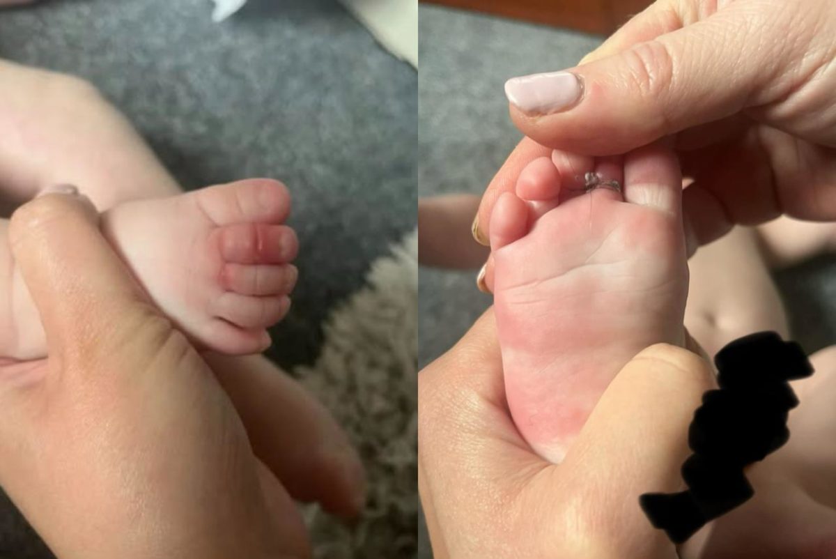 mae-faz-alerta-sobre-lavagem-de-roupa-apos-bebe-quase-perder-os-dedos