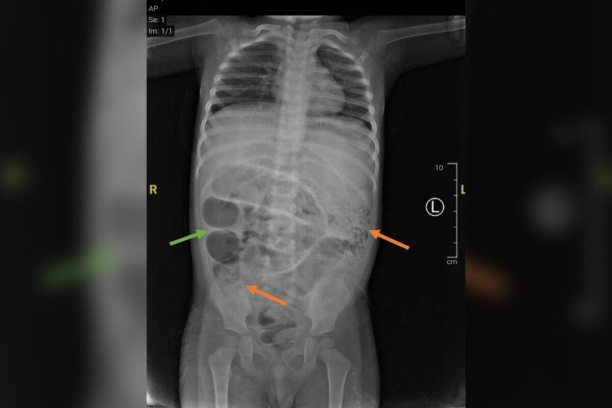 menino-vomita-vermes-horas-depois-de-ser-diagnosticado-com-constipacao