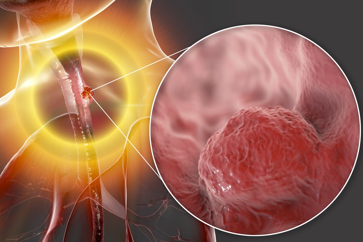 veja-as-causas-e-os-sintomas-do-cancer-de-esofago