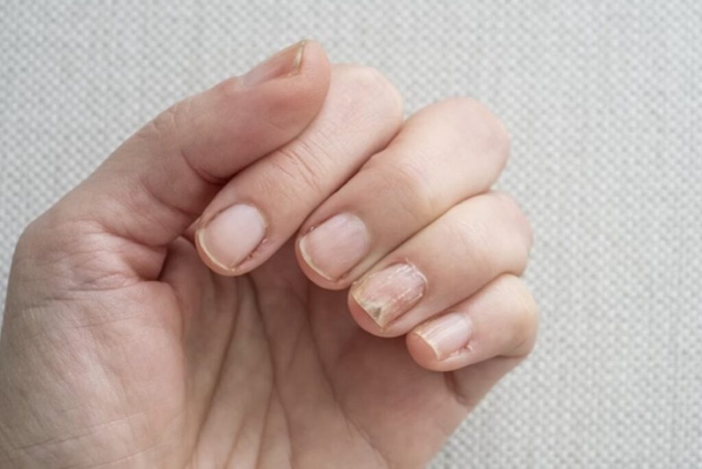 conheca-4-alteracoes-nas-unhas-que-podem-indicar-problemas-de-saude