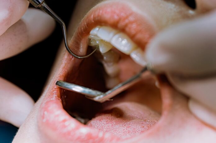 cinco-duvidas-sobre-as-caries-e-como-trata-las