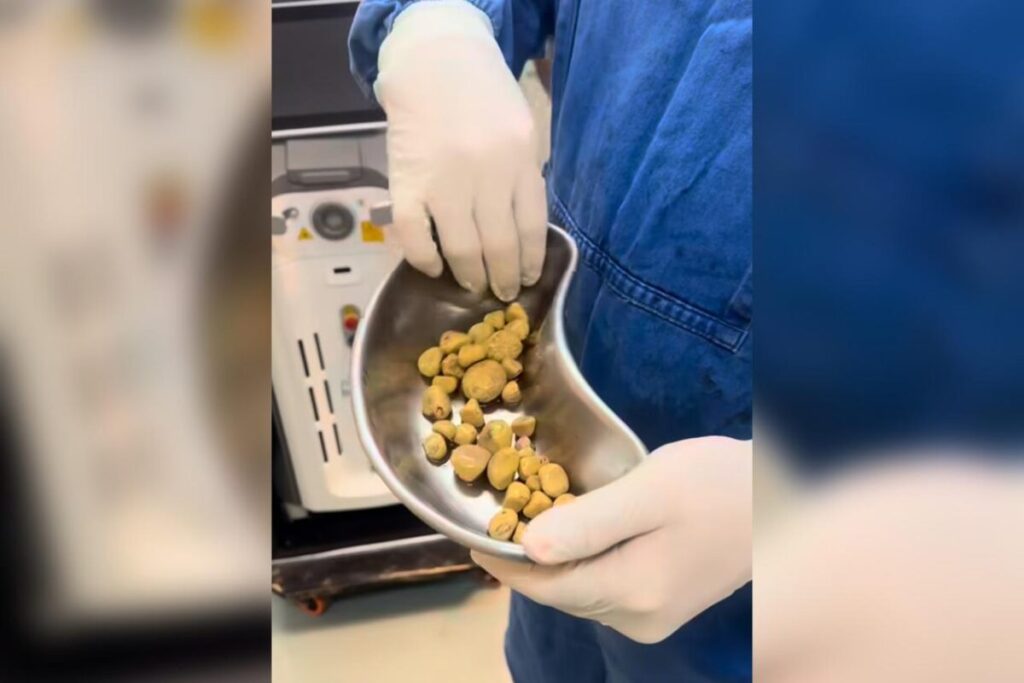 medico-retira-35-pedras-da-bexiga-de-homem-viciado-em-refrigerante
