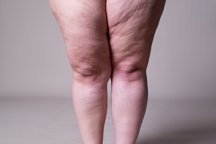 lipedema-e-linfedema:-entenda-as-diferencas-e-como-tratar