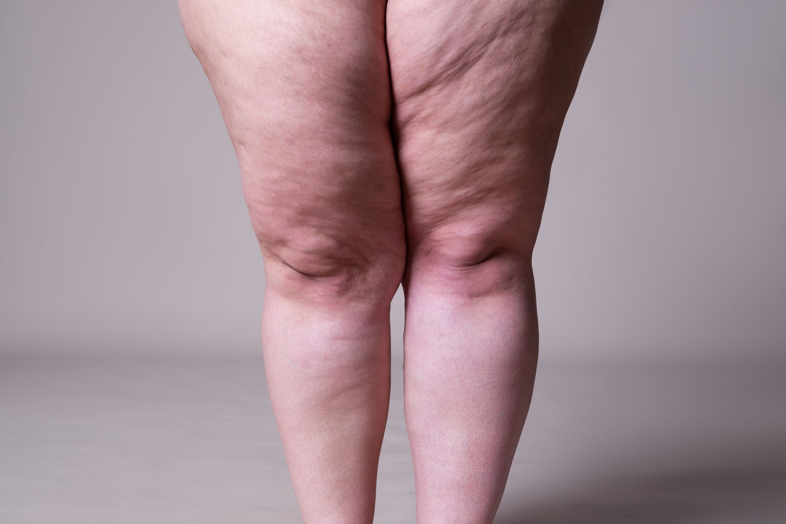 lipedema-e-linfedema:-entenda-as-diferencas-e-como-tratar