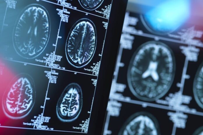sindrome-metabolica-eleva-risco-de-demencia-precoce,-aponta-estudo