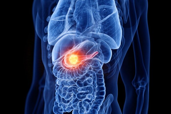 cancer-de-pancreas:-os-sinais-que-seu-corpo-da-e-merecem-atencao