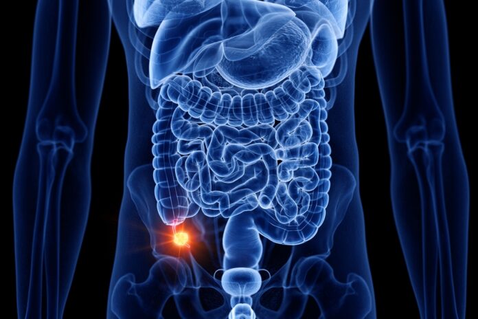 cancer-de-apendice-aumenta-entre-a-geracao-mais-jovem,-mostra-estudo
