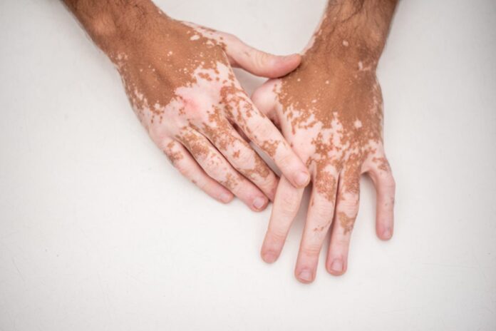 vitiligo:-entenda-causas,-sintomas-e-tratamento