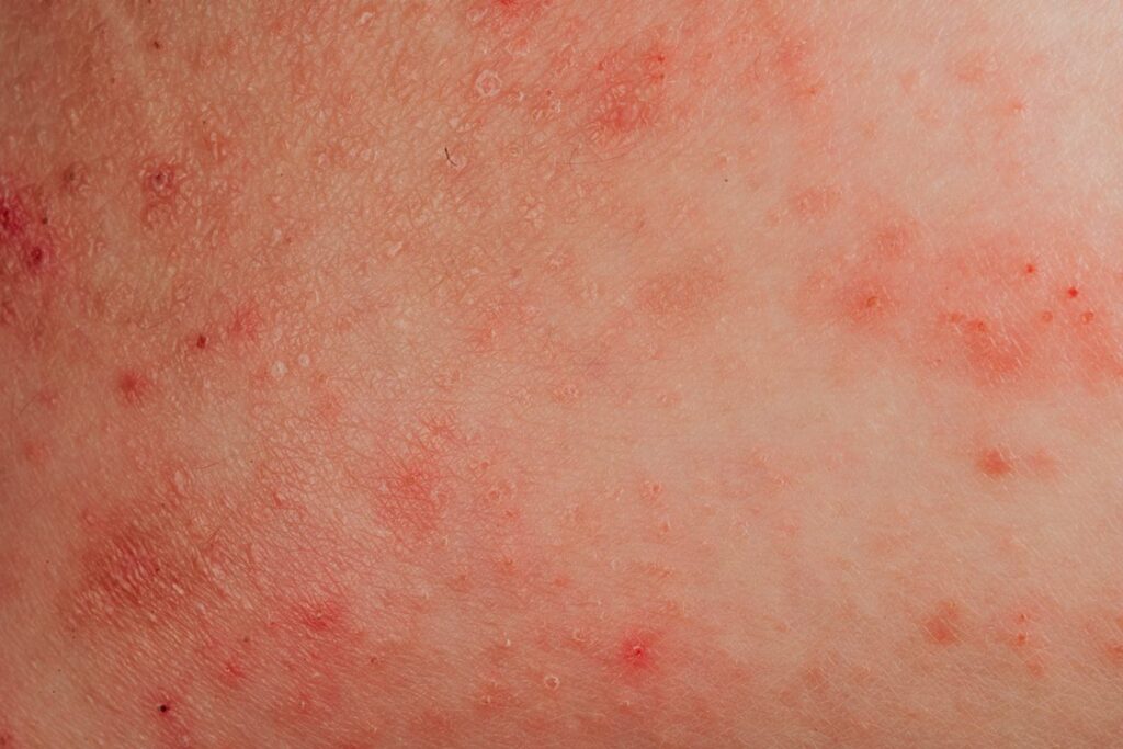 alergia-a-agua:-condicao-real-ou-desculpa-para-nao-tomar-banho?