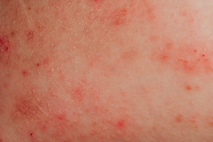 alergia-a-agua:-condicao-real-ou-desculpa-para-nao-tomar-banho?