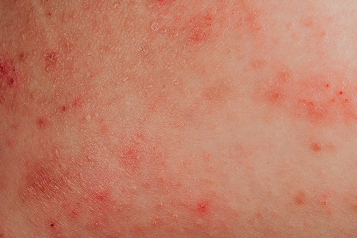 alergia-a-agua:-condicao-real-ou-desculpa-para-nao-tomar-banho?