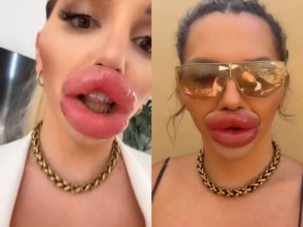 influenciadora-preenche-tanto-os-labios-ao-ponto-de-nao-conseguir-fechar-a-boca