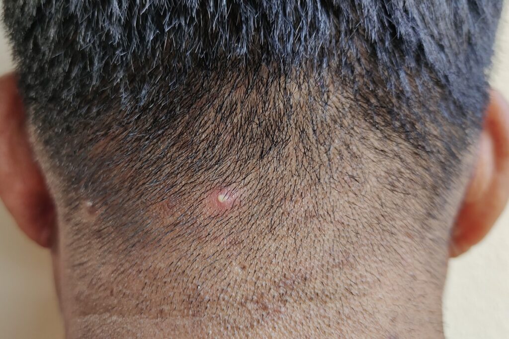 acne-no-couro-cabeludo:-especialista-explica-como-tratar-a-condicao