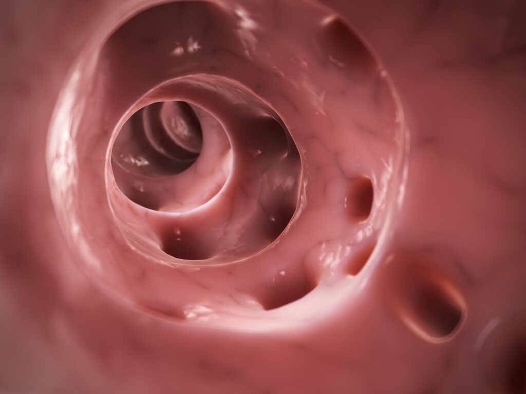 diverticulite-em-jovens-vem-crescendo:-entenda-como-prevenir