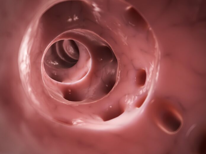 diverticulite-em-jovens-vem-crescendo:-entenda-como-prevenir