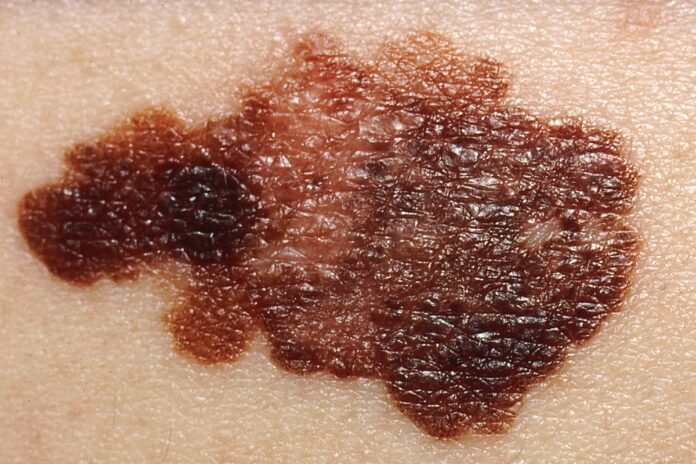 virus-da-herpes-modificado-reduz-melanoma-avancado-em-ensaio-clinico